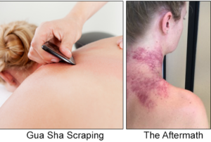 gua sha scraping